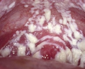 vaginalnyj-kandidoz-simptomy-lechenie